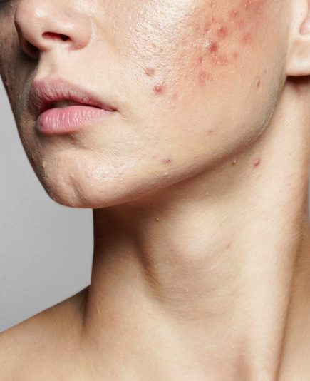 A young woman with bad skin. Skin with a lot of pimples. Acne disease, acne treatment