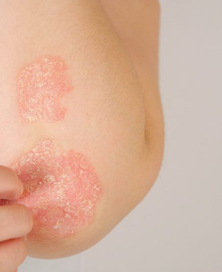 CLOSE UP: Unrecognizable young woman suffering from autoimmune incurable dermatological skin disease called psoriasis. Female gently scratching red, inflamed, scaly rash on elbows. Psoriatic arthritis