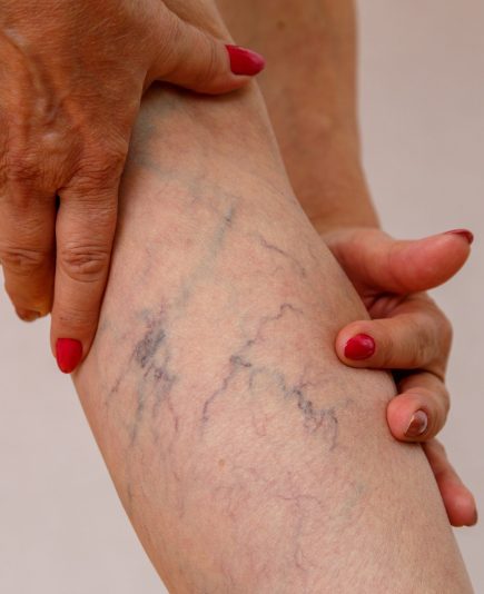 varicose veins of eldelry woman.