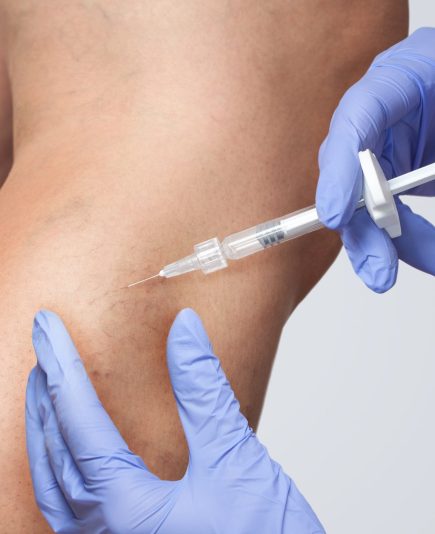 A doctor does medical procedure Sclerotherapy used to eliminate varicose veins and spider veins. An injection of a solution directly into the vein.