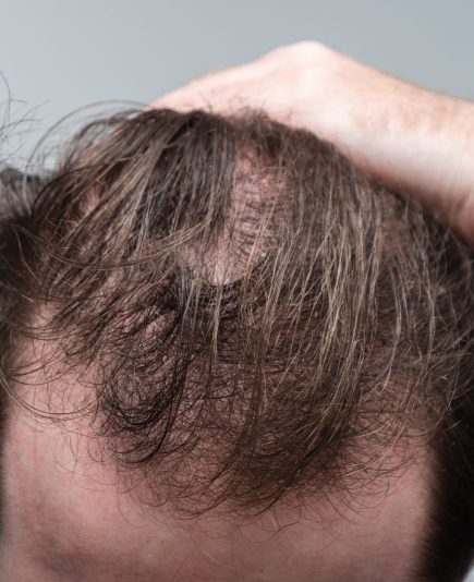 Close up of a young man holding his hair back showing clear signs of a receding hairline and hair loss. First stages of male pattern baldness with bald patches and thinning hair.