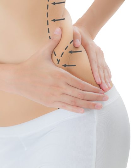 Close up woman grabbing skin on her flanks with the drawing black arrows, Lose weight and liposuction cellulite removal concept, Isolated on white background.