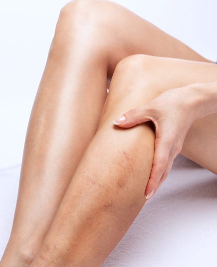 Beautiful slender woman sits on a couch in a spa salon. She shows varicose veins in the lower legs.Treatment of varicose veins and capillaries.